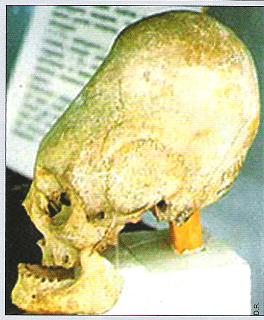 crâne dolichocéphale